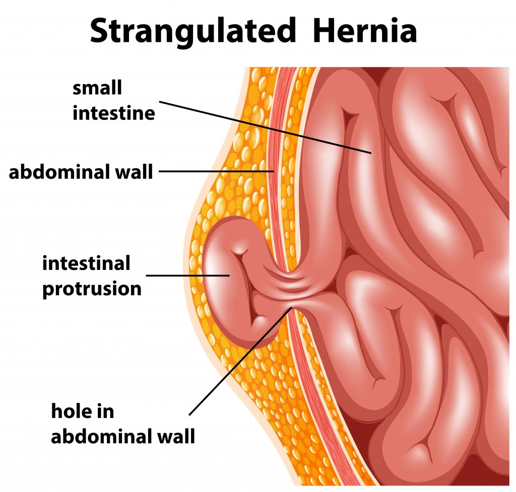Hernia – Tipuri de hernii, simptome, complicatii, tratament