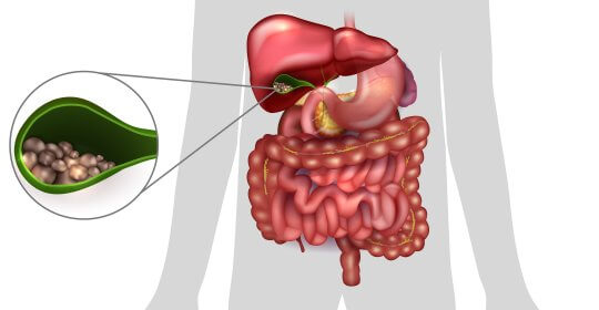 Eliminarea vezicii biliare pentru varice Îndepărtarea vezicii biliare în varicoză