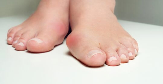 acneea dintre tratamentul degetelor de la picioare