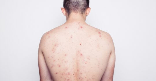 Tipuri de acnee, cauze acnee, tratament si preventie